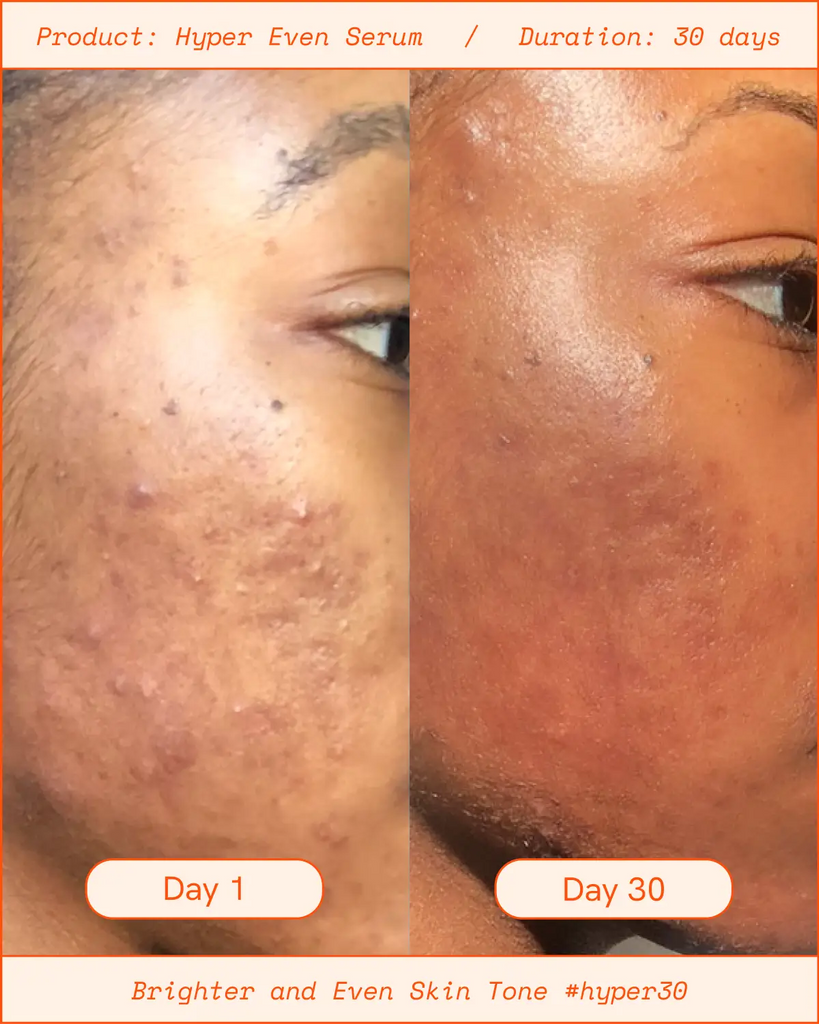 Hyper Even Brightening Dark Spot Vitamin C Serum